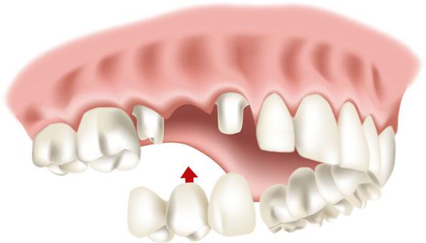 Zahnersatz und ästhetischer Zahnersatz: Wo finden Sie günstige und hochwertige Lösungen? Zahnersatz und ästhetischer Zahnersatz: Wo finden Sie günstige und hochwertige Lösungen?
