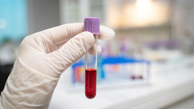 Wichtige Informationen zum C-reaktiven Protein (CRP) im Blut Wichtige Informationen zum C-reaktiven Protein (CRP) im Blut