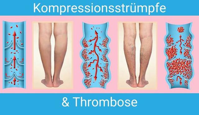 Warum das Tragen von Kompressionsstrümpfen wichtig ist Warum das Tragen von Kompressionsstrümpfen wichtig ist