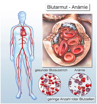 Unbehandelte Blutarmut: Welche Konsequenzen drohen? Unbehandelte Blutarmut: Welche Konsequenzen drohen?