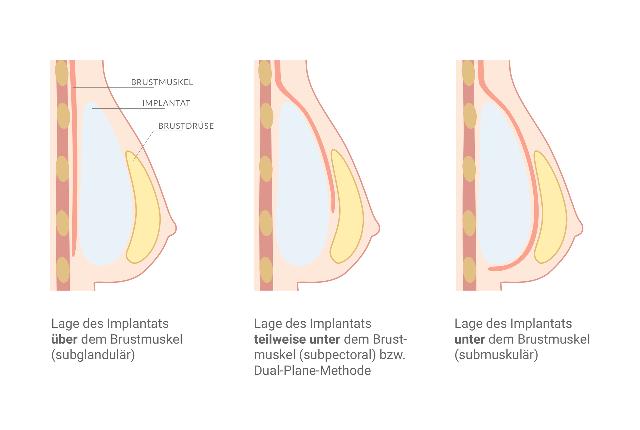 Brustvergrößerung: Wie viel kostet der Eingriff? Brustvergrößerung: Wie viel kostet der Eingriff?