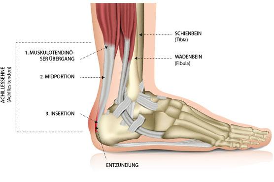 Achillessehne als seelischer wunder Punkt: Die Entstehung und Möglichkeiten zur Heilung