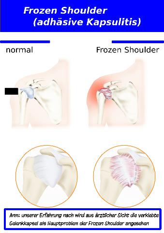 Frozen Shoulder und Spiritualität: Eine Verbindung erkunden