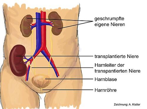 Nierengesundheit in Gefahr: Die häufigsten Ursachen für Nierenschäden