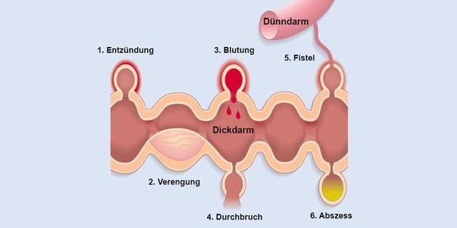Vorbeugung von Divertikulitis: Speiseplan und Bewegung als Schutzmaßnahmen Vorbeugung von Divertikulitis: Speiseplan und Bewegung als Schutzmaßnahmen