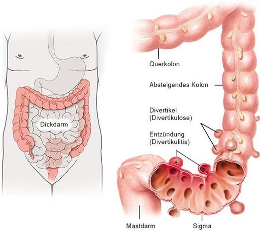 Divertikulitis-Diagnose: Symptome erkennen und ärztlichen Rat einholen Divertikulitis-Diagnose: Symptome erkennen und ärztlichen Rat einholen