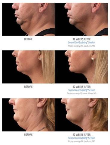 Effektive Methoden gegen das lästige Doppelkinn