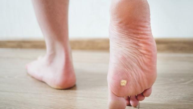 Dornwarzen selber behandeln: Hausmittel und frei verkäufliche Produkte im Überblick