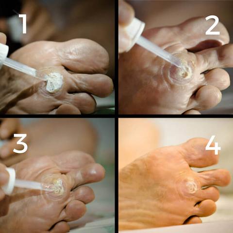 Selbstbehandlung von Dornwarzen: Hausmittel und Mittel aus der Apotheke