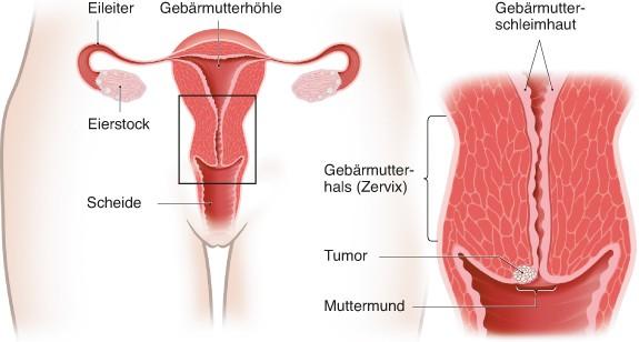 Dysplasie des Gebärmutterhalses: Ursachen und Risikofaktoren Dysplasie des Gebärmutterhalses: Ursachen und Risikofaktoren