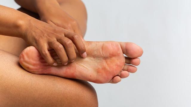 Schnelle Hilfe bei Hautpilz: Effektive Behandlungsmethoden Schnelle Hilfe bei Hautpilz: Effektive Behandlungsmethoden