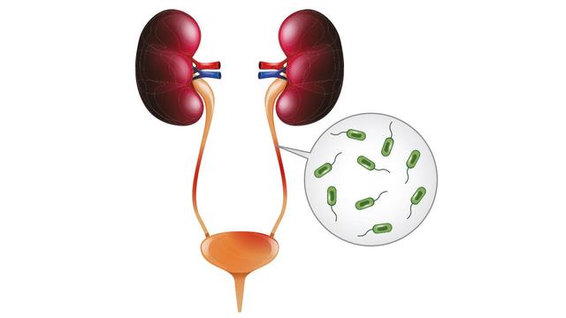 Die besten Methoden, um Bakterien in der Blase abzutöten