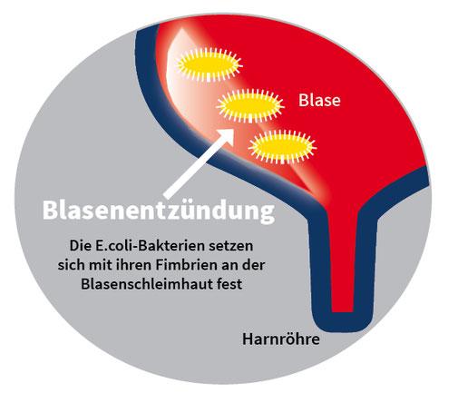 Tipps zur erfolgreichen Beseitigung von Bakterien in der Blase