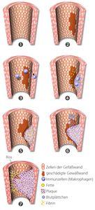 Plaque-Entfernung in der Halsschlagader: Revolutionäre Technik mit Ultraschall und Laser Plaque-Entfernung in der Halsschlagader: Revolutionäre Technik mit Ultraschall und Laser