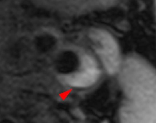 Sicher und effektiv: Neue Therapieoption gegen Plaques in der Halsschlagader Sicher und effektiv: Neue Therapieoption gegen Plaques in der Halsschlagader