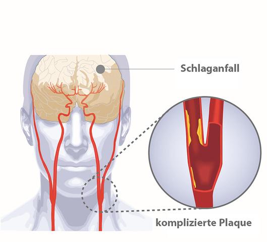 Ultraschall und Laser: Innovative Lösung gegen Plaques in der Halsschlagader Ultraschall und Laser: Innovative Lösung gegen Plaques in der Halsschlagader