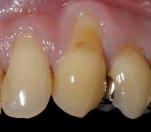 Welche Möglichkeiten gibt es bei einem Härtefall bei Zahnersatz?