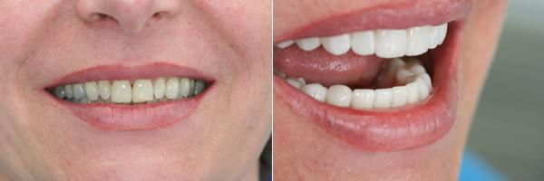 Kosten für Veneers: Was kostet ein schönes Lächeln?