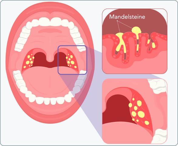 Hausmittel gegen Mundgeruch durch Mandelsteine: So können Sie sie selbst loswerden Hausmittel gegen Mundgeruch durch Mandelsteine: So können Sie sie selbst loswerden