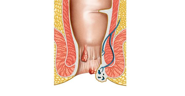 Was tun bei äußeren Hämorrhoiden? Sofortige Hilfe und wirksame Hausmittel