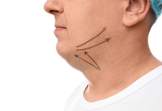 Ursachen für ein Doppelkinn und wie man dagegen vorgehen kann