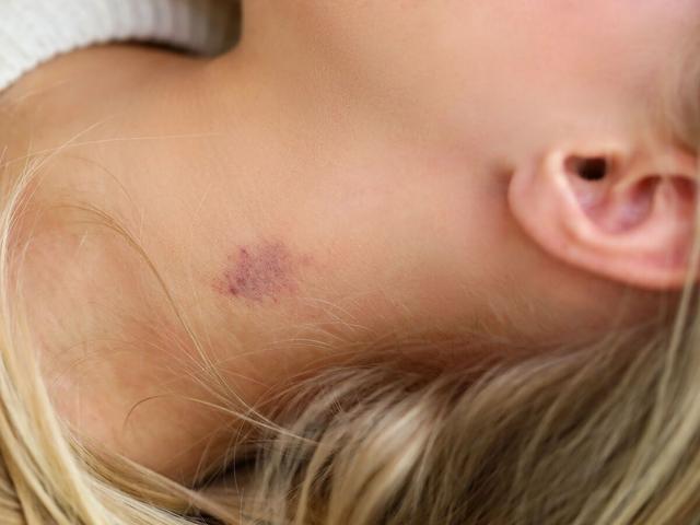 Knutschfleck-Notfallplan: Sofortmaßnahmen zur Entfernung von Knutschflecken Knutschfleck-Notfallplan: Sofortmaßnahmen zur Entfernung von Knutschflecken