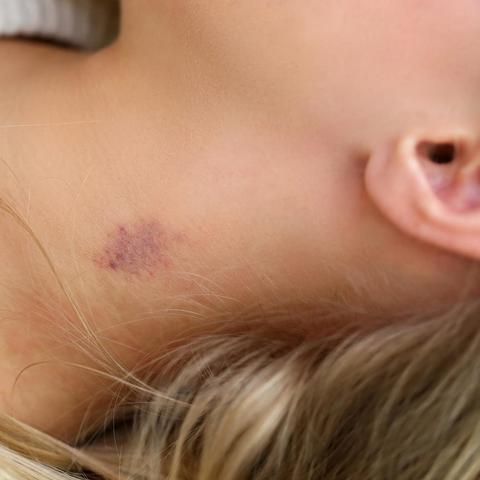 Entferne Knutschflecken im Handumdrehen: Praktische Tipps und Mittel Entferne Knutschflecken im Handumdrehen: Praktische Tipps und Mittel