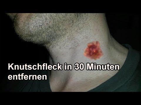 Effektive Hausmittel gegen Knutschflecke: So wirst du sie schnell los Effektive Hausmittel gegen Knutschflecke: So wirst du sie schnell los