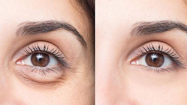 Tipps und Tricks, um Augenringe dauerhaft zu reduzieren Tipps und Tricks, um Augenringe dauerhaft zu reduzieren