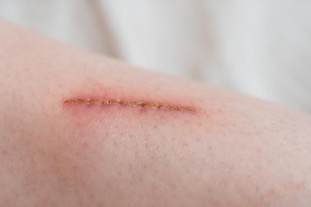 Pflegetipps für eine frische Narbe, die spannt