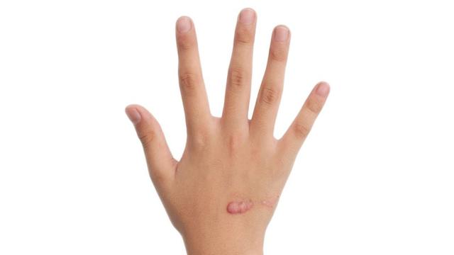 Was tun, wenn eine Narbe juckt und spannt?