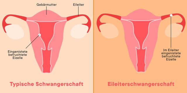 Eileiterschwangerschaft: Wann können Schmerzen auftreten? Eileiterschwangerschaft: Wann können Schmerzen auftreten?