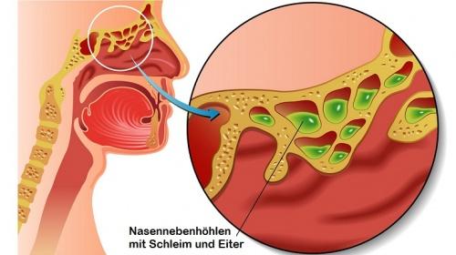Verstopfte Nase: Einblick in die Nasenhöhle