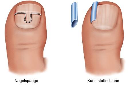 Wie man einen eingewachsenen Zehennagel selbst behandeln kann Wie man einen eingewachsenen Zehennagel selbst behandeln kann