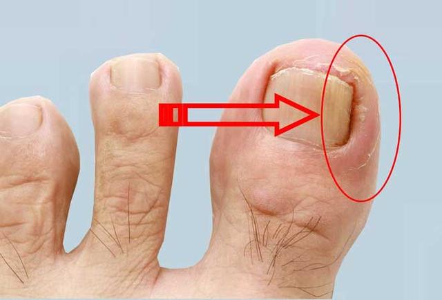 Die besten Möglichkeiten, einen eingewachsenen Zehennagel zu Hause zu behandeln Die besten Möglichkeiten, einen eingewachsenen Zehennagel zu Hause zu behandeln