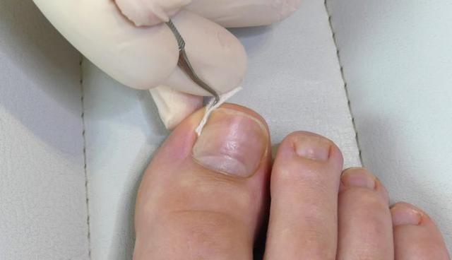 Effektive Methoden zur Selbstbehandlung von eingewachsenen Zehennägeln
