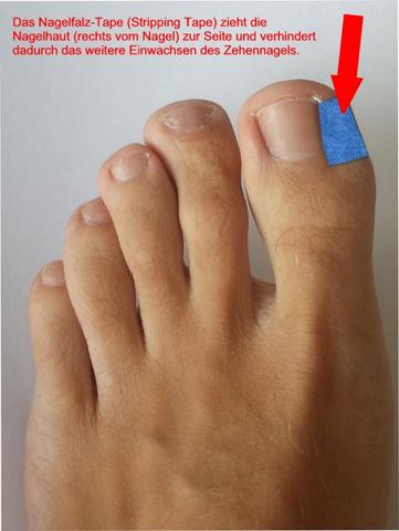 Hausmittel und Techniken zum Entfernen von eingewachsenen Zehennägeln
