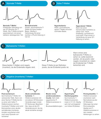 Interpretation der nach unten gerichteten Zacken im EKG