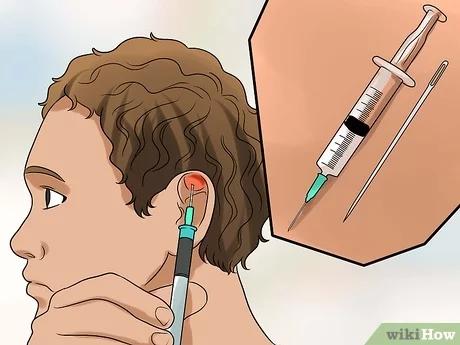 Do-it-yourself: Blumenkohlohr selber machen leicht gemacht auf TikTok