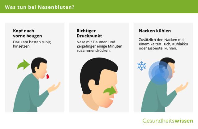 Richtig handeln bei Nasenbluten: Praktische Anleitungen Richtig handeln bei Nasenbluten: Praktische Anleitungen