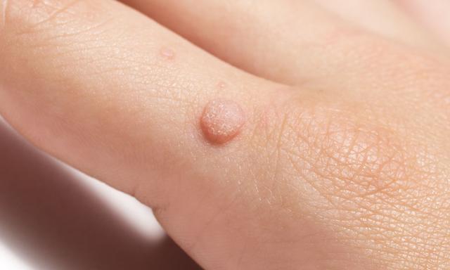 Expertenrat für die Selbstbehandlung von Feigwarzen Expertenrat für die Selbstbehandlung von Feigwarzen