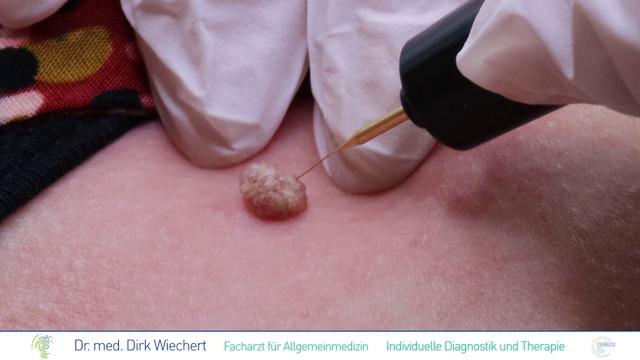Selbstbehandlung von Fibromen: Hausmittel und alternative Lösungen Selbstbehandlung von Fibromen: Hausmittel und alternative Lösungen