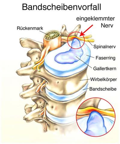 Hilfe bei Bandscheibenvorfall: Welche Anträge kann ich stellen?