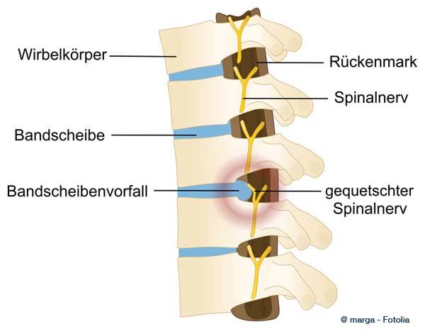 Finanzielle Unterstützung bei Bandscheibenvorfall: Welche Leistungen kann ich beantragen?