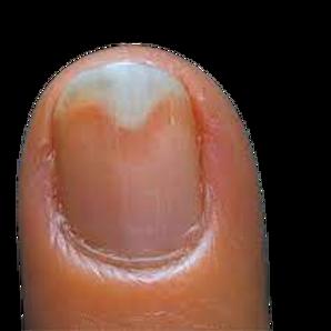 Onycholyse: Gründe für das Ablösen von Fingernägeln und geeignete Handlungsweisen