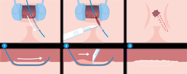 Fistelheilung ohne medizinische Eingriffe: Ist es möglich? Fistelheilung ohne medizinische Eingriffe: Ist es möglich?