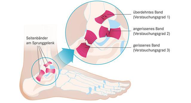Soforthilfe bei einem verstauchten Fuß: Tipps und Tricks