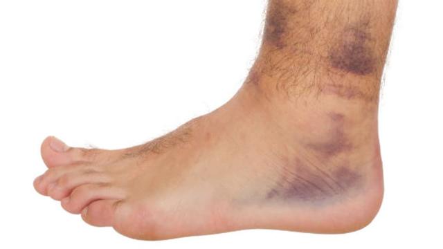 Richtig reagieren: Maßnahmen bei einer Fußverstauchung