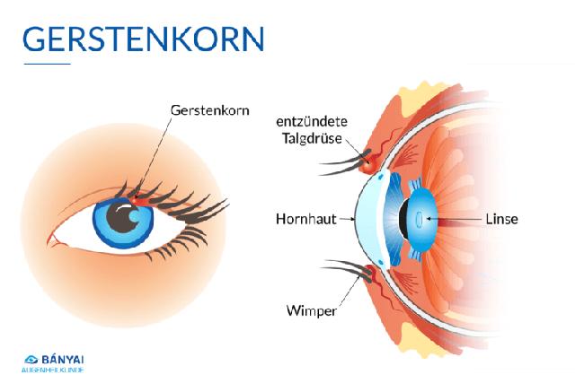 Was tun bei einem Gerstenkorn? Tipps zur Linderung der Beschwerden und schnellen Heilung