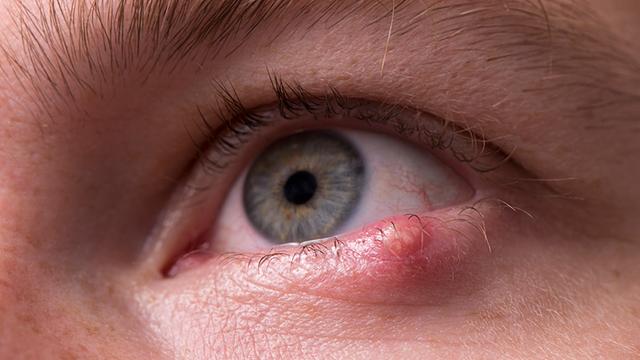 Vorbeugung und Behandlung von Gerstenkorn: Tipps und Maßnahmen